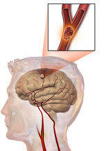 Cerebral Cortex, Brainstem Syndromes, Stroke