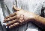 Viral infections, Scabies, Leishmaniasis, Leprosy