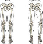 Osteoporosis, Pagets disease, Osteogenesis Imperfecta