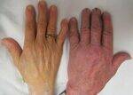 Nutritional Deficiency Anemia