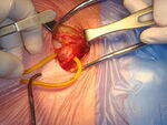 Hernia