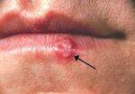 Sexually Transmitted Diseases - Warts, Syphilis, Herpes