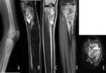 Bone Tumors