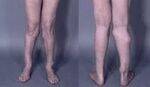 Classfication, Fibrous Dysplasia, Bone cysts, Exostosis, Enchondroma, Chondroblastoma, Osteoid Osteoma