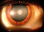 Lens and Acquired Cataract