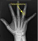 Osteoblastoma, GCT, Hemangioma, Osteosarcoma, Ewings Sarcoma