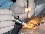 Cataract Surgery, Endophthalmitis, Congenital Cataract