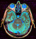 Hypopituitarism, ADH, SIADH