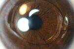 Lens and Cataract