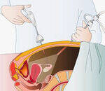 Minimally invasive surgery - Laparoscopy, Robotic surgery