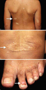 Genodermatosis and Connective Tissue Diseases