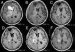 CNS Radiology - Stroke, Fancy conditions, Trauma, Tumors, Infections
