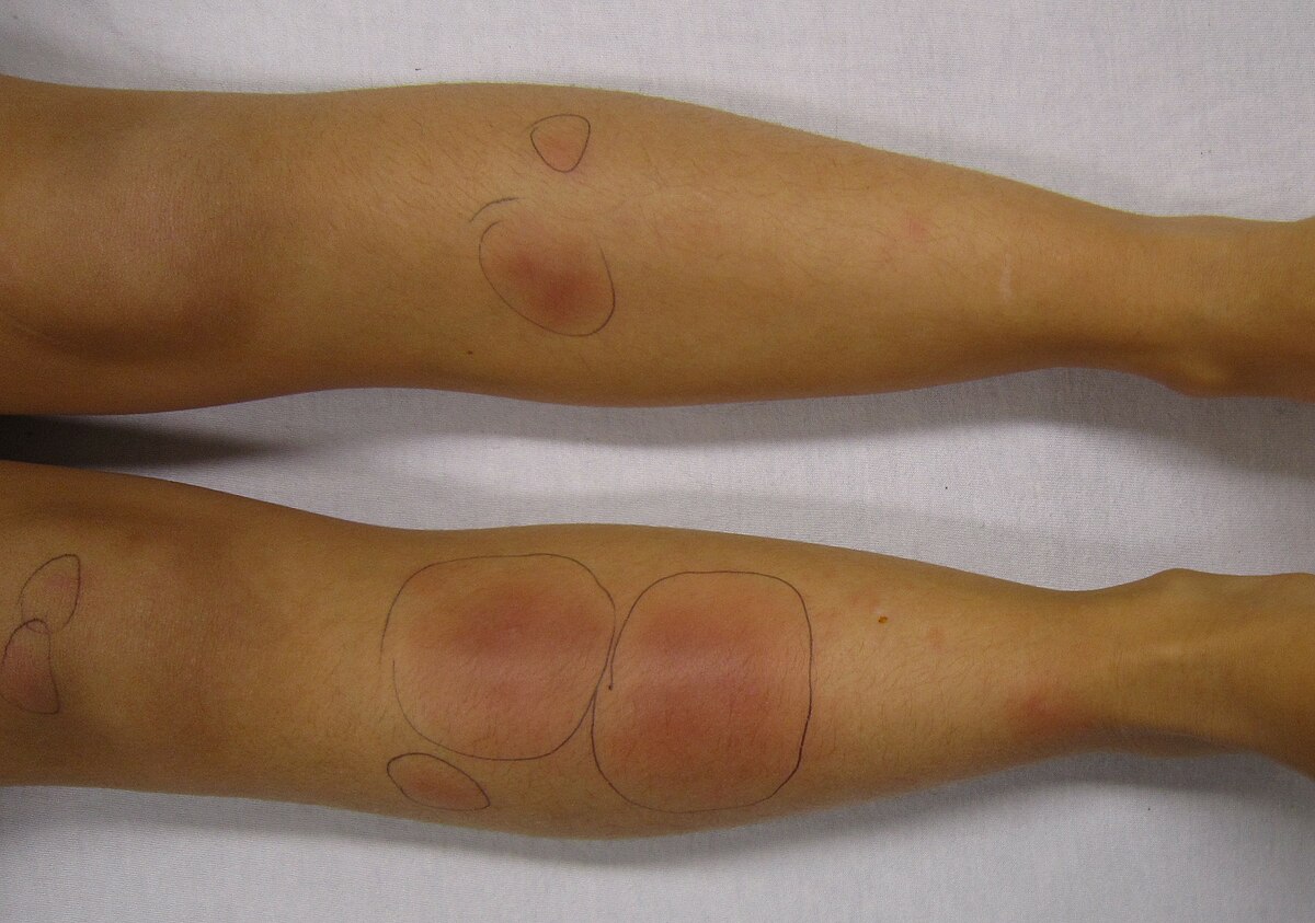 Cutaneous drug reactions and Miscellaneous - TEN, SJS