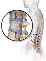 Spine - Fractures, PIVD, Spondylolisthesis, Scoliosis