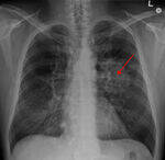 Respiratory Path - Obstructive, Restrictive, Granulomatous Diseases, Lung Ca