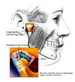 Oral Cavity- Leukoplakia and Erythroplakia, Oral Ca