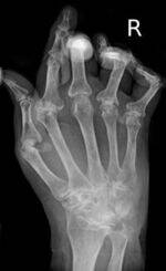Musculoskeletal Radiology - RA, AS, Gout, TB, Bone Tumors